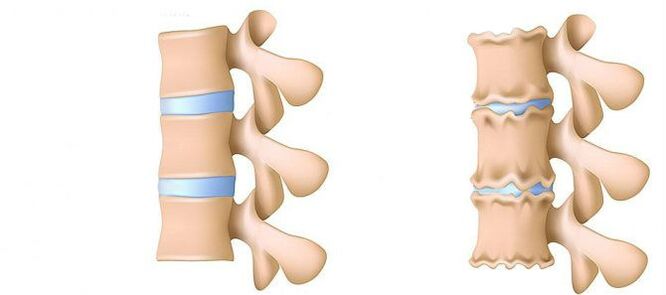 Zer da osteochondrosia