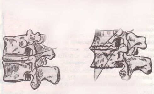 Disko intervertebral osasuntsua da eta lumbar osteochondrosisarekin