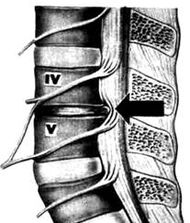 X-Lumbar Osteokondrosia Saileko argazkia