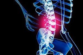 lumbar bizkarrezurraren osteokondrosia