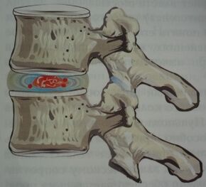 Osteokondrosiaren lehen fasea