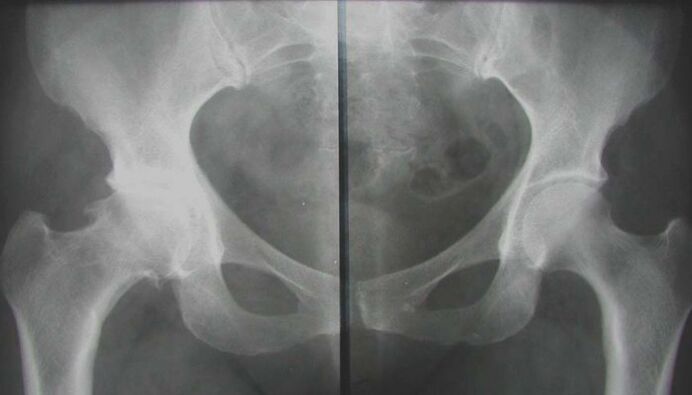 artrosiarekin kaltetutako hip artikulazioaren erradiografia